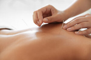 Acupuncture on a back